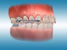 Appareil orthodontique