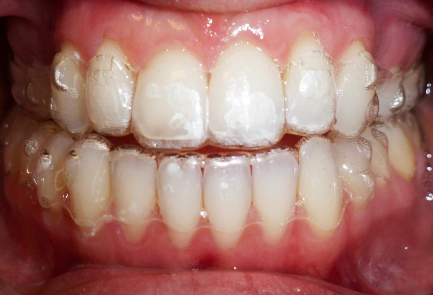 Coquilles transparentes Invisalign | Ortho Lévis, Orthodontiste à Lévis ...